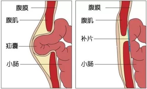 腹腔镜疝气修补术图解图片