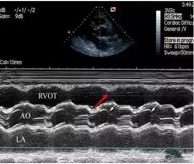 作为最特异的超声心动图特征,当右室/左室前后径比值 > 0.