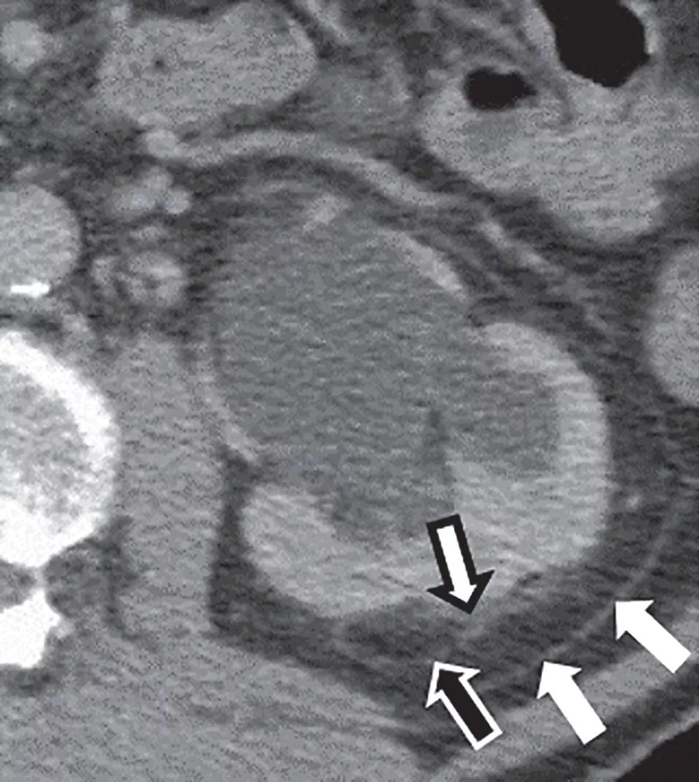 急性输尿管梗阻的影像学表现