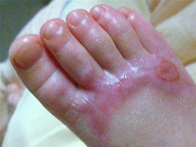 孩子被烫伤,先脱衣服还是冲水?第一步很重要,做错伤情加剧