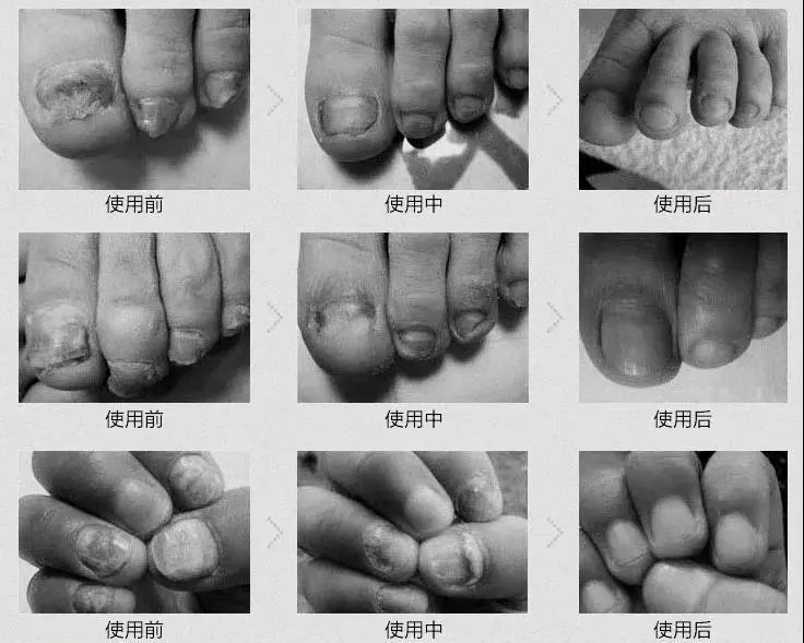 灰指甲反复不愈用它1步轻松护理15天指甲光亮如初