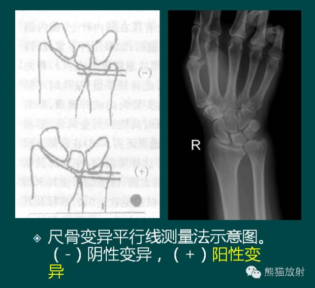 尺骨撞擊綜合徵ulnarimpactionsyndromeuis