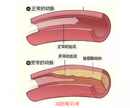 心脑血管能引起肥胖吗?