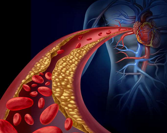 诱发病变死亡的人则是高达300万,所以该疾病被称为"隐形杀手"一点没错