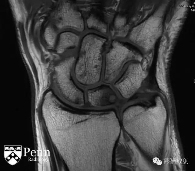 尺骨撞击综合征ulnarimpactionsyndromeuis