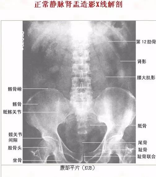 髂骨x线解剖图图片