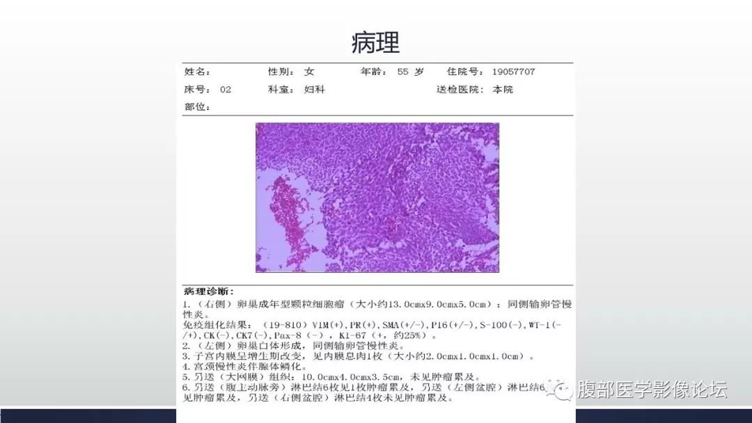 垂体颗粒细胞瘤图片