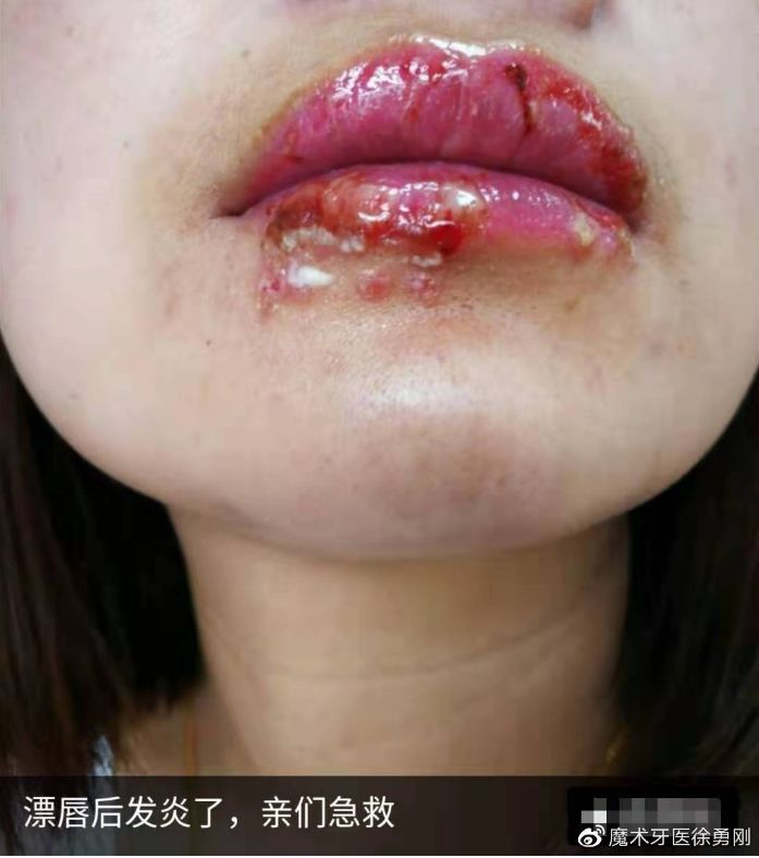 地导致唇部干裂敏感,红唇渐渐失去滋润与光泽,不定期不可预料的发炎