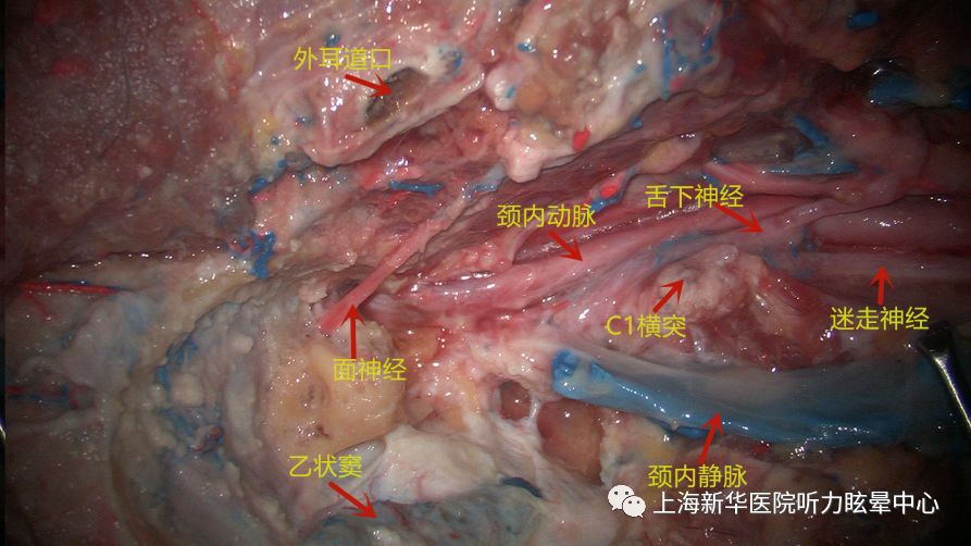 面神經,乙狀竇,頸靜脈球,頸內靜脈,頸內外動脈,椎靜脈,以及舌咽神經