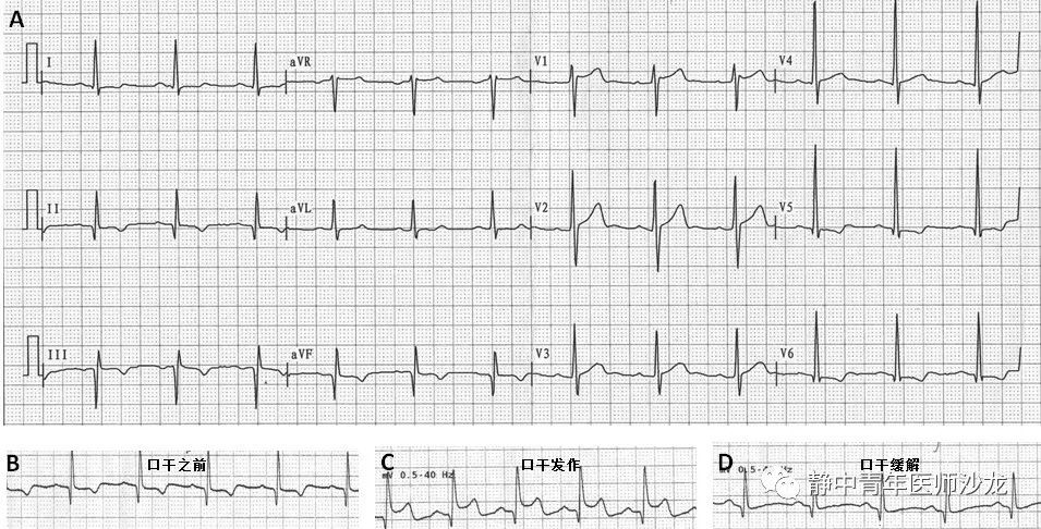 原創陣發性口乾心電圖一過性st段抬高