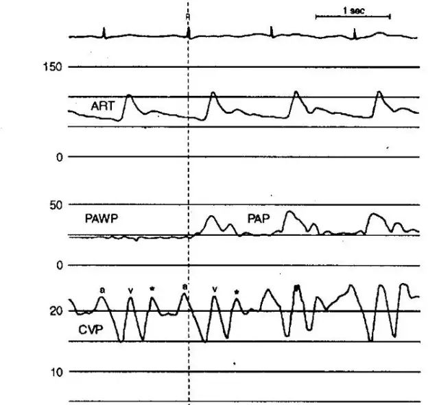 心包填塞:cvp波形呈单相,x段明显且变陡,y段缩短甚至消失(fig10,11.