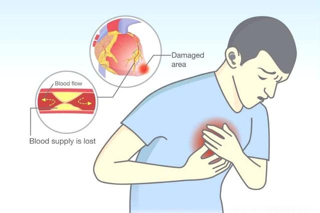 胃食管反流病胸痛和其他疾病引起的胸痛怎么区分怎么治疗67