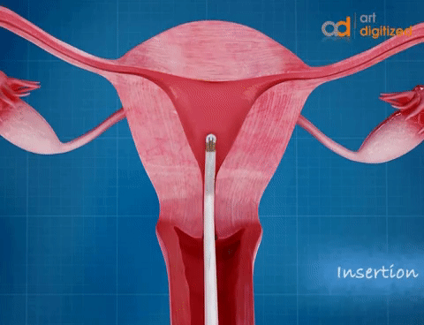 就是在女性子宫内部放置宫内节育器,可以达到长期避孕的效果,其原理是