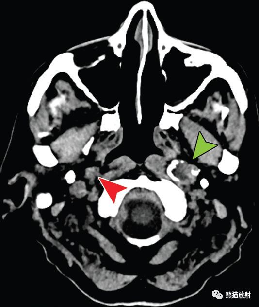 顱底解剖及相關病變丨ct平掃的價值