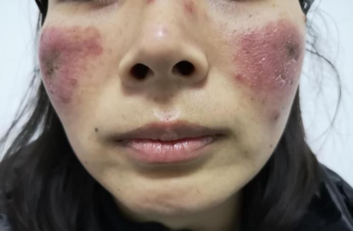 系统性红斑狼疮患者的"旅游"注意事项!