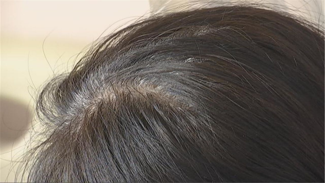 15岁少年突患急性白血病 39岁母亲一夜白头