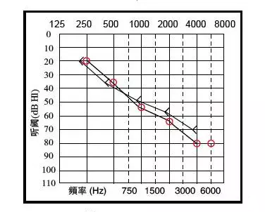 感音神经性听力损失的听力图表现为:气导,骨导均不正常,气导听阈>25db