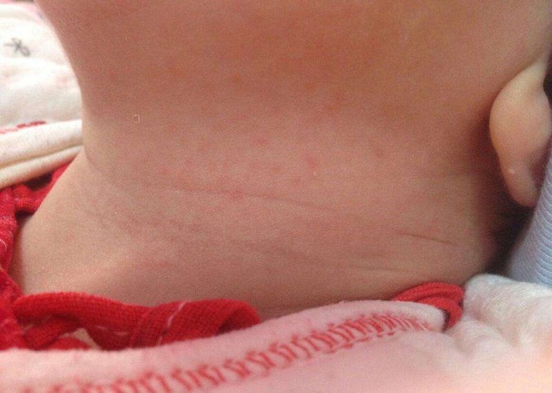 10个月大宝宝,接种疫苗后不幸夭折,孩子有这些情况,不能打疫苗