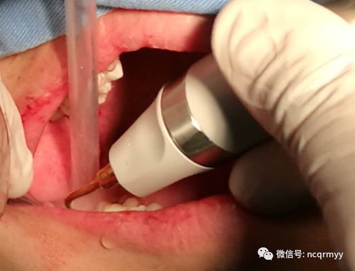 南川区人民医院口腔科开展了首例超声骨刀下阻生智齿拔出,患者拔牙后