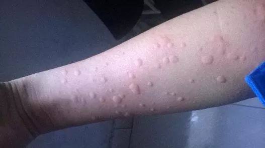 麻疹,这是一种比较令人困扰的疾病,它是临床上常见的变态反应性皮肤病