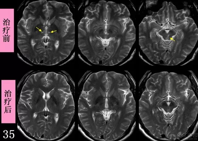 颅脑mri表现丘脑内侧核团,红核,大脑导水管周围灰质可见明显的异常高
