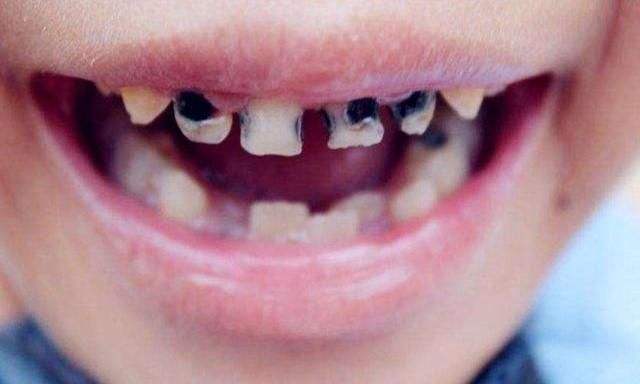 满嘴"小黑牙"真的是因为喜欢吃糖吗?还有可能因为无知的父母!