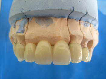 想要镶假牙 知道哪种材质适合你吗?