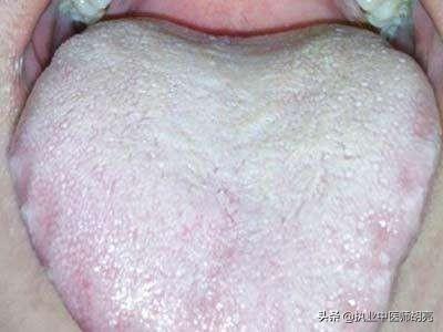舌头上两条唾液线图片图片