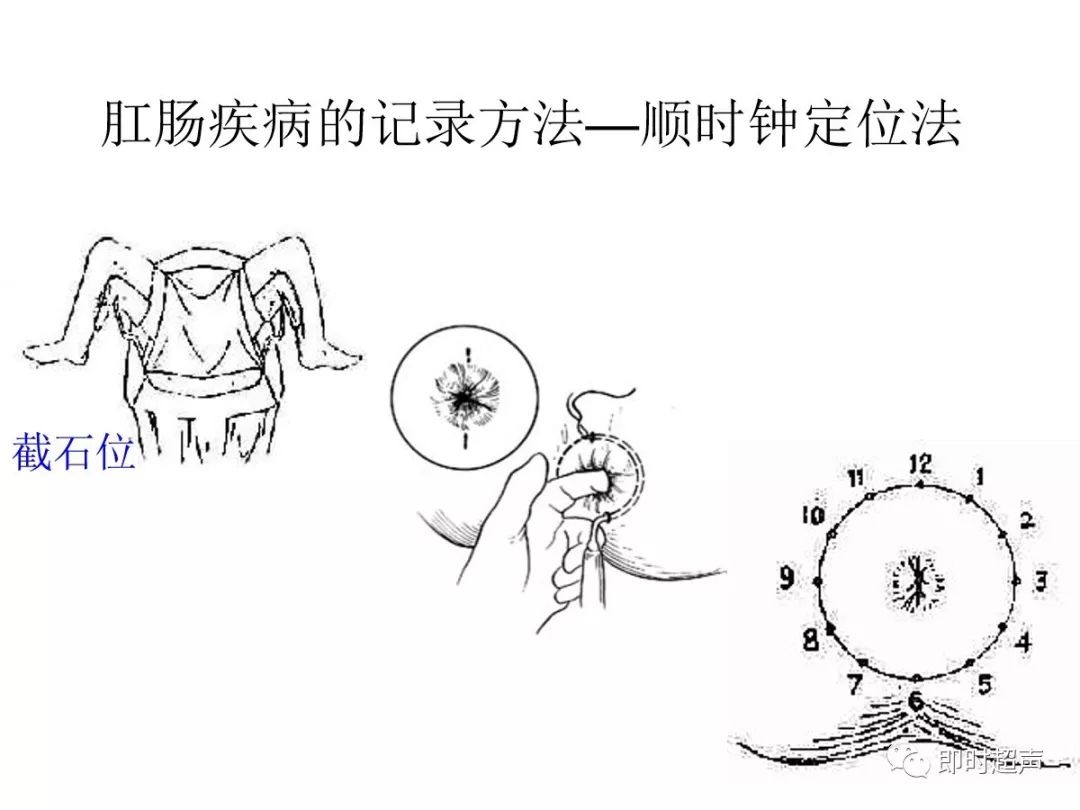 分型和数量确定脓肿的部位和范围明确瘘管和肛门括约肌的关系3