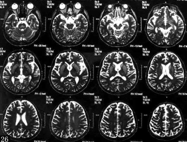 影像表现 mri示半卵圆中心脑白质区有小片状长t1