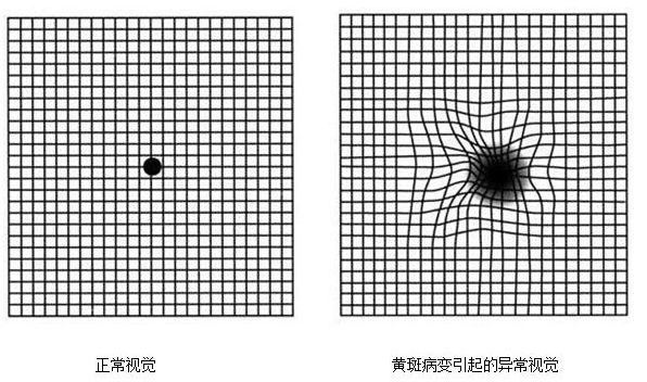 同仁眼科专家刘武一个小方法在家就能自测黄斑病变