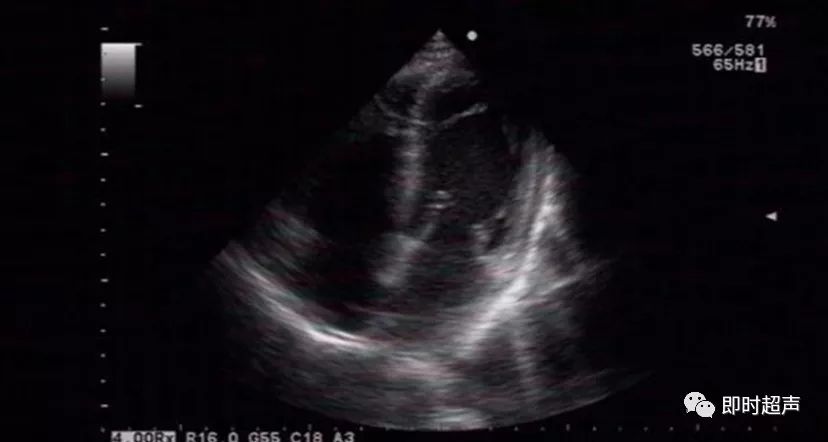 左心室假腱索的超声诊断