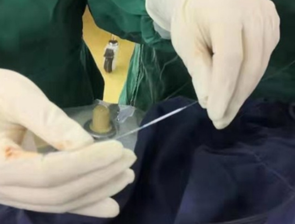 内蒙古首例冠状动脉自灌注药物球囊在内蒙古人民医院心脏中心导管室