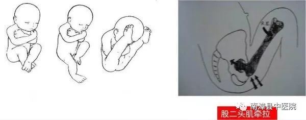 固定装置治疗的ddh患者(另外,ddh危险因素还包括:巨大儿,胎儿过度成熟