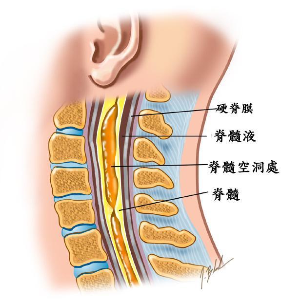 脊髓出现空洞千万别大意