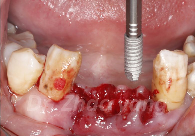骨再生案例大赏糖尿病患者下颌前牙区即刻种植引导骨再生