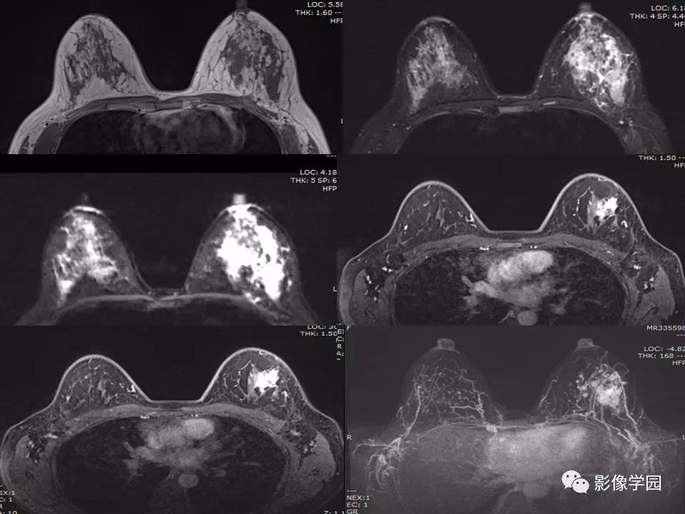 非哺乳期乳腺炎性病变与炎性乳癌影像诊断