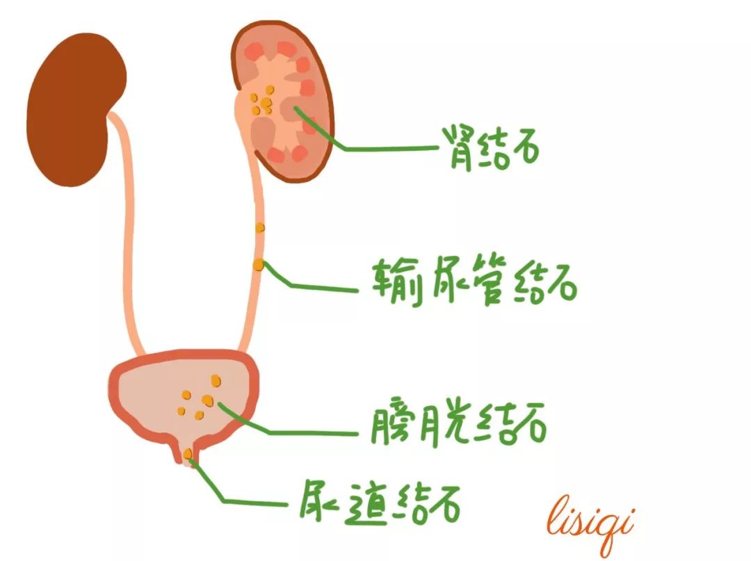 尿结石示意图图片