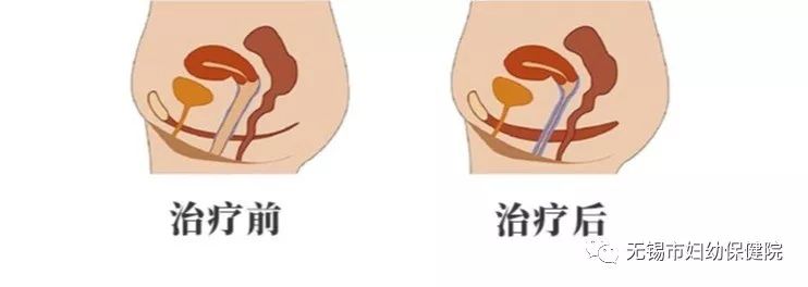 婦幼科普生完孩子還要漏尿這可怎麼辦