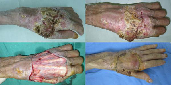 宋红霞主任提醒大家:警惕这些疤痕恶变的危险信号!_癌变