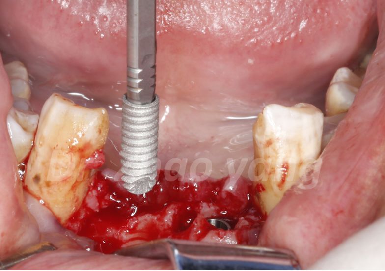 骨再生案例大赏糖尿病患者下颌前牙区即刻种植引导骨再生