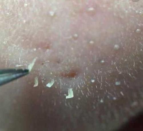 皮脂腺分泌旺盛 来自搜狐网