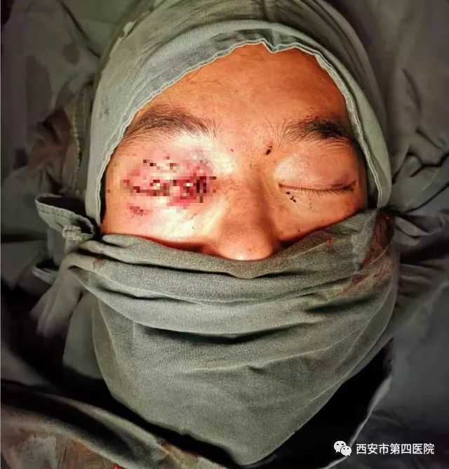 急救车送到西安市第四医院眼外伤中心,经医院急诊科诊断为:右眼球脱臼