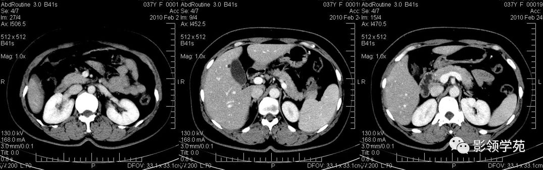 胰腺癌的影像诊断