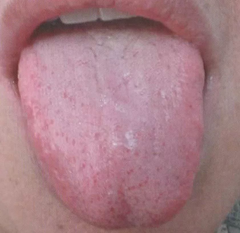 肺火大的舌苔图片图片