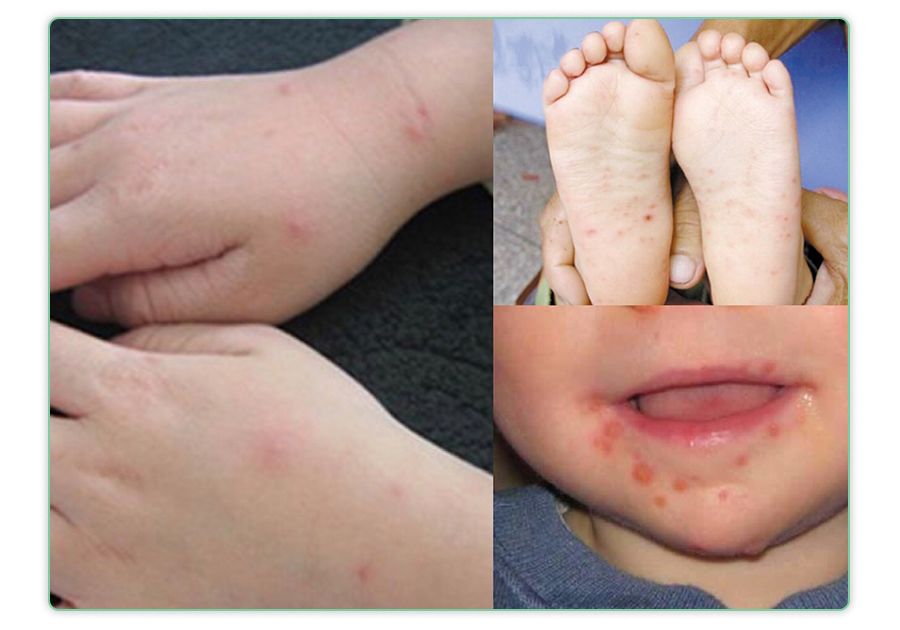 手足口病典型症状·有的娃还可能伴有恶心,呕吐,乏力,咽喉疼痛等全身