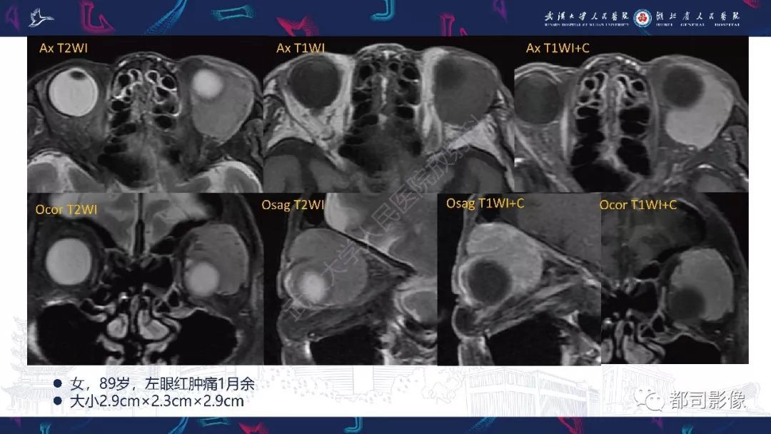 关于眼眶胚胎性横纹肌肉瘤影像诊断