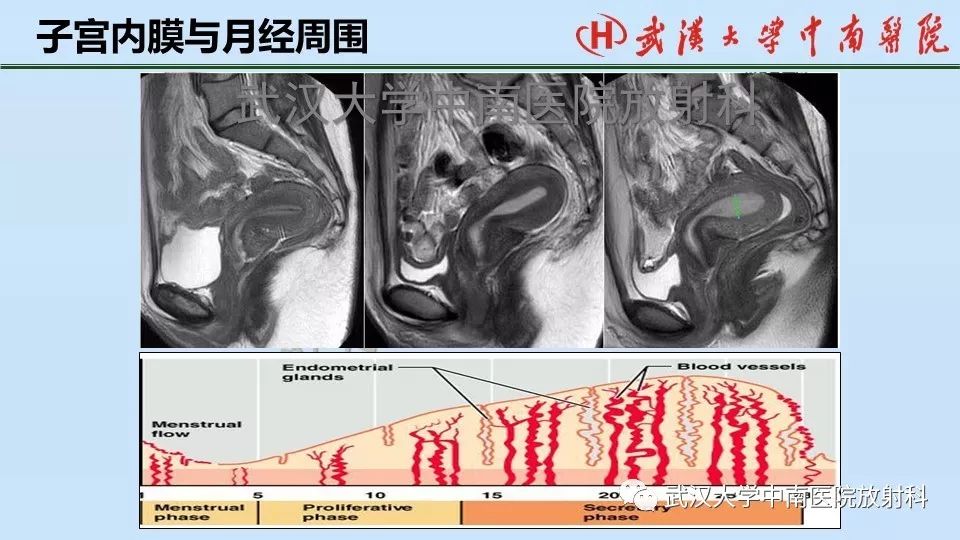 女性生殖系統影像解剖及子宮常見疾病作者:胡金香來源:武漢大學中南