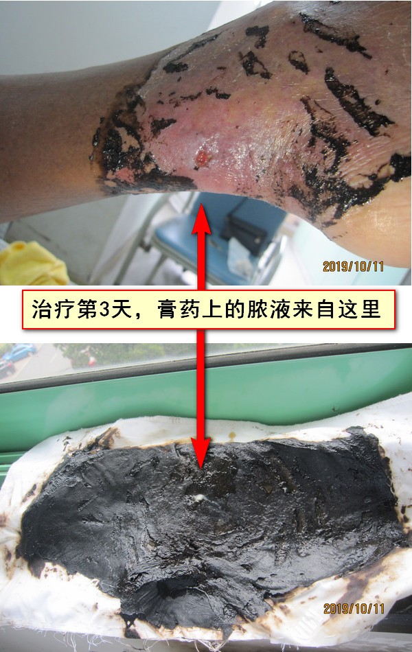 贴膏药为什么会拔出脓