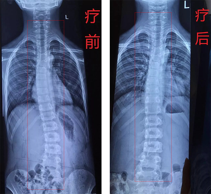 康睿仕案例分享  13岁脊柱侧弯15度